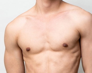 Gynecomastia Surgery